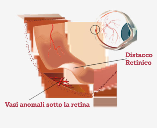 Cheratocono avanzato